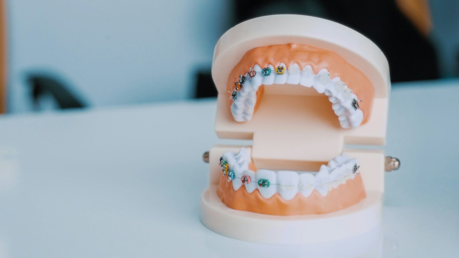 Aparelho Dentário: Tipos, Indicações e Cuidados